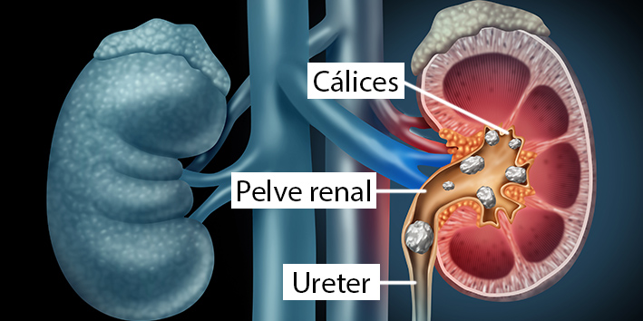 MITOS SOBRE O CÁLCULO RENAL, A FAMOSA ‘PEDRA’ NOS RINS
