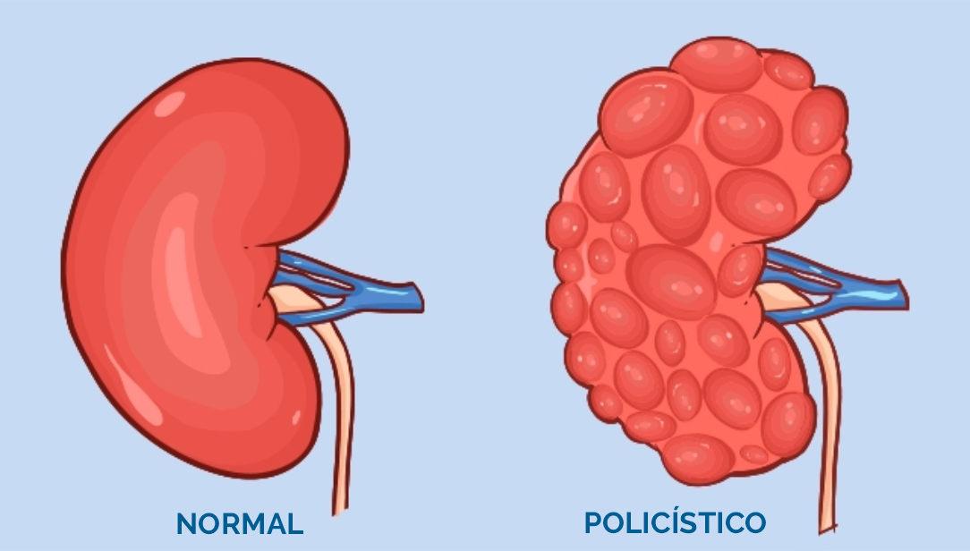 Rins Policísticos, você já ouviu falar?